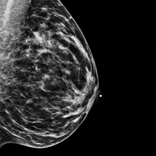 mammographie résoscan